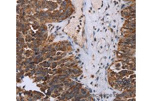 Immunohistochemistry of Human breast cancer using DDX11 Polyclonal Antibody at dilution of 1:30 (DDX11 抗体)
