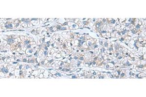 Immunohistochemistry of paraffin-embedded Human liver cancer tissue using GDF9 Polyclonal Antibody at dilution of 1:55(x200) (GDF9 抗体)