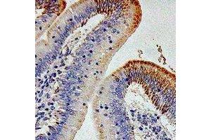 Immunohistochemical analysis of CD212 staining in human colon cancer formalin fixed paraffin embedded tissue section. (IL12RB1 抗体)