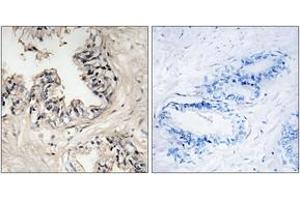 Immunohistochemistry analysis of paraffin-embedded human prostate carcinoma tissue, using MRPS36 Antibody. (MRPS36 抗体  (AA 4-53))