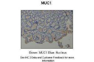 Sample Type :  Human stomach  Primary Antibody Dilution :  1:500  Secondary Antibody :  Anti-rabbit-HRP  Secondary Antibody Dilution :  1:1000  Color/Signal Descriptions :  Brown: MUC1 Blue: Nucleus  Gene Name :  MUC1  Submitted by :  Dr. (MUC1 抗体  (C-Term))