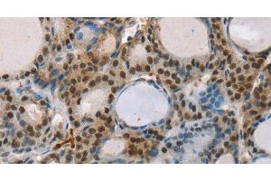 Immunohistochemistry of paraffin-embedded Human thyroid cancer tissue using RUNX1T1 Polyclonal Antibody at dilution 1:35