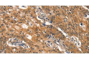 Immunohistochemistry of paraffin-embedded Human gastic cancer using DNM2 Polyclonal Antibody at dilution of 1:40 (DNM2 抗体)
