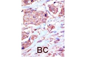 Formalin-fixed and paraffin-embedded human cancer tissue reacted with the primary antibody, which was peroxidase-conjugated to the secondary antibody, followed by DAB staining. (EPH Receptor B6 抗体  (C-Term))
