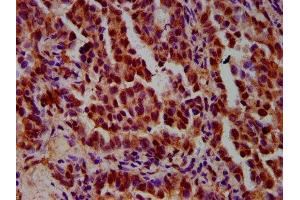 IHC image of ABIN7156289 diluted at 1:600 and staining in paraffin-embedded human lung cancer performed on a Leica BondTM system. (IMPDH1 抗体  (AA 191-281))