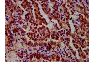 IHC image of ABIN7156289 diluted at 1:600 and staining in paraffin-embedded human lung cancer performed on a Leica BondTM system.