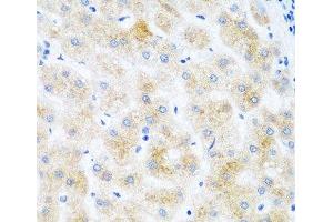Immunohistochemistry of paraffin-embedded Human liver cancer using DHODH Polyclonal Antibody at dilution of 1:100 (40x lens). (DHODH 抗体)