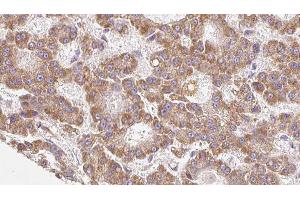 ABIN6279168 at 1/100 staining Human liver cancer tissue by IHC-P. (ABCC8 抗体)