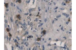 DAB staining on IHC-P; Samples: Human Lung cancer Tissue (RNASE3 抗体  (AA 30-154))