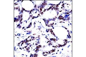 HNRN Antibody (N-term) ((ABIN657930 and ABIN2846875))immunohistochemistry analysis in formalin fixed and paraffin embedded human colon carcinoma followed by peroxidase conjugation of the secondary antibody and DAB staining. (HNRNPM 抗体  (N-Term))