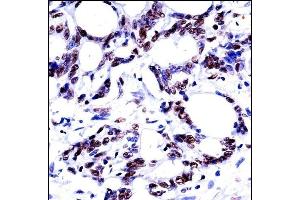 HNRN Antibody (N-term) ((ABIN657930 and ABIN2846875))immunohistochemistry analysis in formalin fixed and paraffin embedded human colon carcinoma followed by peroxidase conjugation of the secondary antibody and DAB staining.