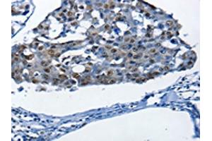 The image on the left is immunohistochemistry of paraffin-embedded Human breast cancer tissue using ABIN7190003(BPIFB1 Antibody) at dilution 1/25, on the right is treated with synthetic peptide. (BPIFB1 抗体)