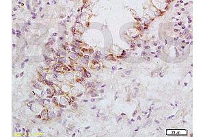 Formalin-fixed and paraffin embedded: human rectal carcinoma labeled with Anti-FasL Polyclonal Antibody, Unconjugated (ABIN726410) at 1:200, followed by conjugation to the secondary antibody and DAB staining