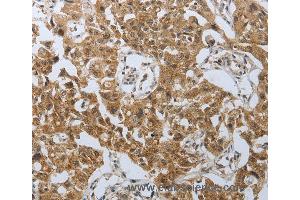 Immunohistochemistry of Human lung cancer using PSMD6 Polyclonal Antibody at dilution of 1:40 (PSMD6 抗体)