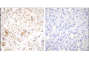 Immunohistochemistry analysis of paraffin-embedded human breast carcinoma tissue, using Cyclin F Antibody. (Cyclin F 抗体  (AA 737-786))