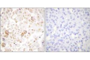Immunohistochemistry analysis of paraffin-embedded human breast carcinoma tissue, using Cyclin F Antibody. (Cyclin F 抗体  (AA 737-786))