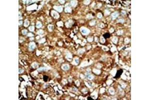 Immunohistochemistry (IHC) image for anti-6-phosphofructo-2-Kinase/fructose-2,6-Biphosphatase 3 (PFKFB3) (AA 454-484) antibody (ABIN3029823)