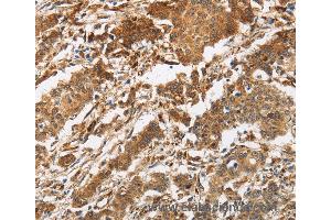 Immunohistochemistry of Human liver cancer using CALU Polyclonal Antibody at dilution of 1:40