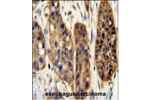 KIL Antibody (N-term) (ABIN654924 and ABIN2844567) immunohistochemistry analysis in formalin fixed and paraffin embedded human esophagus carcinoma followed by peroxidase conjugation of the secondary antibody and DAB staining. (KIAA1324-Like 抗体  (N-Term))