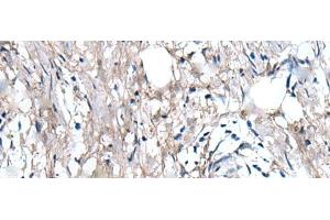 Immunohistochemistry of paraffin-embedded Human gastric cancer tissue using WRN Polyclonal Antibody at dilution of 1:55(x200) (RECQL2 抗体)