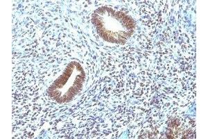 Formalin-fixed, paraffin-embedded human uterine carcinoma stained with MAP3K1 antibody (2F6). (MAP3K1 抗体  (AA 1211-1310))