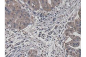 DAB staining on IHC-P; Samples: Human Liver cancer Tissue (CROT 抗体  (AA 410-612))