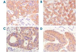 Immunohistochemical analysis of paraffin-embedded human lung squamous cell carcinoma (A) ,normal hepatocyte (B) , colon adenocacinoma? (Cytokeratin 5 抗体)
