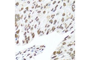 Immunohistochemistry of paraffin-embedded human prostate cancer using HNRNPR antibody at dilution of 1:100 (40x lens). (HNRNPR 抗体)