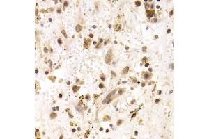 Immunohistochemistry of paraffin-embedded human liver cancer using PRPF3 Antibody (ABIN1876670) at dilution of 1:100 (40x lens). (PRPF3 抗体)