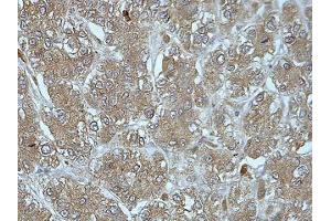 IHC analysis of formalin-fixed paraffin-embedded liver cancer tissue with cytoplasmic staining, using FUCA2 antibody (1/100 dilution). (FUCA2 抗体  (AA 312-467))