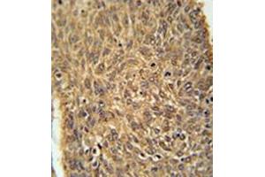 Immunohistochemistry analysis in formalin fixed and paraffin embedded human lung carcinoma reacted with KIAA0652 Antibody (N-term) followed which was peroxidase conjugated to the secondary antibody and followed byDAB staining. (ATG13 抗体  (N-Term))