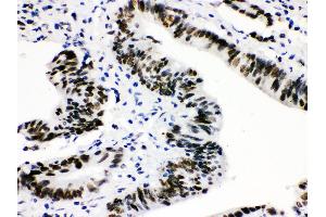 Anti-CTBP2 Picoband antibody, IHC(P) IHC(P): Human Intestinal Cancer Tissue (CTBP2 抗体  (AA 321-445))