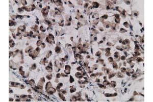 Immunohistochemical staining of paraffin-embedded Adenocarcinoma of Human colon tissue using anti-GPHN mouse monoclonal antibody. (Gephyrin 抗体)
