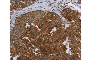 Immunohistochemistry of Human ovarian cancer using SNCG Polyclonal Antibody at dilution of 1:60 (SNCG 抗体)
