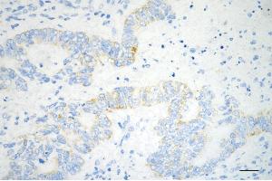 Immunohistochemistry was performed on paraffin-embedded human sigmoid colon carcinoma using glutaminase antibody (ABIN7798747), 1:200).