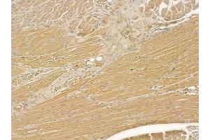 ABIN6264087 and ABIN6277086 at 1/100 staining human tongue carcinoma by IHC-P.