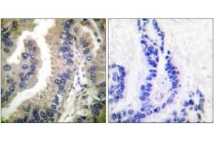 Immunohistochemistry analysis of paraffin-embedded human lung carcinoma tissue, using HSP90A Antibody. (HSP90AA1 抗体  (AA 683-732))