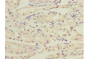 Immunohistochemistry of paraffin-embedded human gastric cancer using ABIN7167348 at dilution of 1:100 (RAB4B 抗体  (AA 2-213))