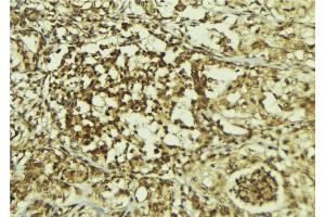 ABIN6267213 at 1/100 staining Human breast cancer tissue by IHC-P. (CDK6 抗体  (pTyr24))