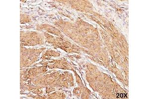 IHC staining of human leiomyosarcoma (20X) with Muscle actin antibody (HHF35). (Actin 抗体)