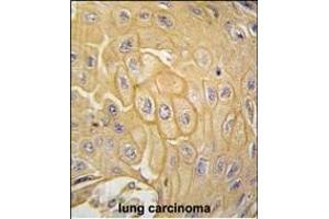 Formalin-fixed and paraffin-embedded human lung carcinoma tissue reacted with MCK10 antibody (ABIN392016 and ABIN2841793) , which was peroxidase-conjugated to the secondary antibody, followed by DAB staining. (DDR1 抗体)