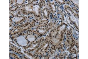 Immunohistochemistry of Human thyroid cancer using NBL1 Polyclonal Antibody at dilution of 1:50 (PARN 抗体)