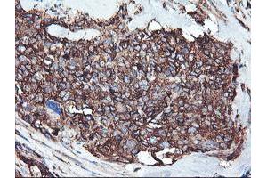 Immunohistochemical staining of paraffin-embedded Adenocarcinoma of Human breast tissue using anti-CYP2B6 mouse monoclonal antibody. (CYP2B6 抗体)
