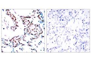 Immunohistochemical analysis of paraffin-embedded human breast carcinoma tissue using c-Jun (Ab-170) antibody (E021023). (C-JUN 抗体)