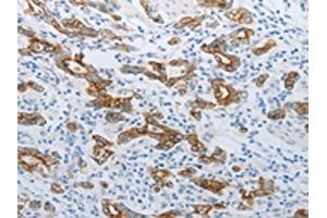 The image on the left is immunohistochemistry of paraffin-embedded Human gastric cancer tissue using ABIN7192809(TMEM8B Antibody) at dilution 1/15, on the right is treated with synthetic peptide. (TMEM8B 抗体)