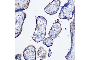 Immunohistochemistry of paraffin-embedded human colon carcinoma using cGAS Rabbit pAb (ABIN6134073, ABIN6143590, ABIN6143591 and ABIN6224360) at dilution of 1:50 (40x lens). (C6orf150 抗体  (AA 350-522))