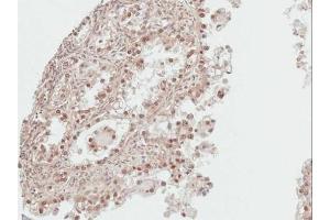 IHC-P Image Immunohistochemical analysis of paraffin-embedded human ovarian cancer, using DDI1, antibody at 1:100 dilution. (DDI1 抗体  (Center))