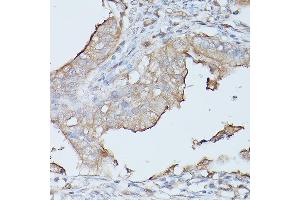 Immunohistochemistry of paraffin-embedded human oophoroma using CE Rabbit pAb (ABIN3015546, ABIN3015547, ABIN3015548 and ABIN6218802) at dilution of 1:100 (40x lens). (CEACAM1 抗体  (AA 300-430))