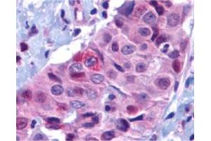 Immunohistochemistry of BBC3 in human breast carcinoma with BBC3 polyclonal antibody  at 10 ug/mL .