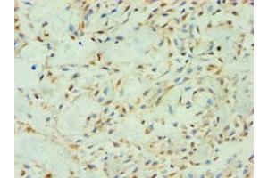 Immunohistochemistry of paraffin-embedded human breast cancer using ABIN7170604 at dilution of 1:100 (Spindlin 2B 抗体  (AA 1-258))